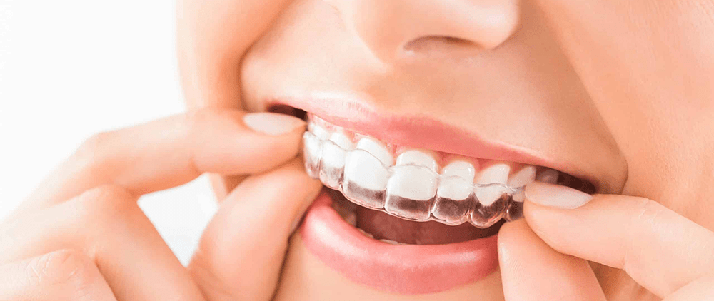 How Do I Replace a Lost Retainer? - Venneir