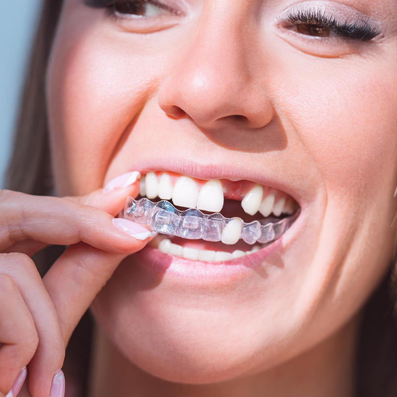 Woman inserting clear retainer with built-in replacement tooth for full smile appearance
