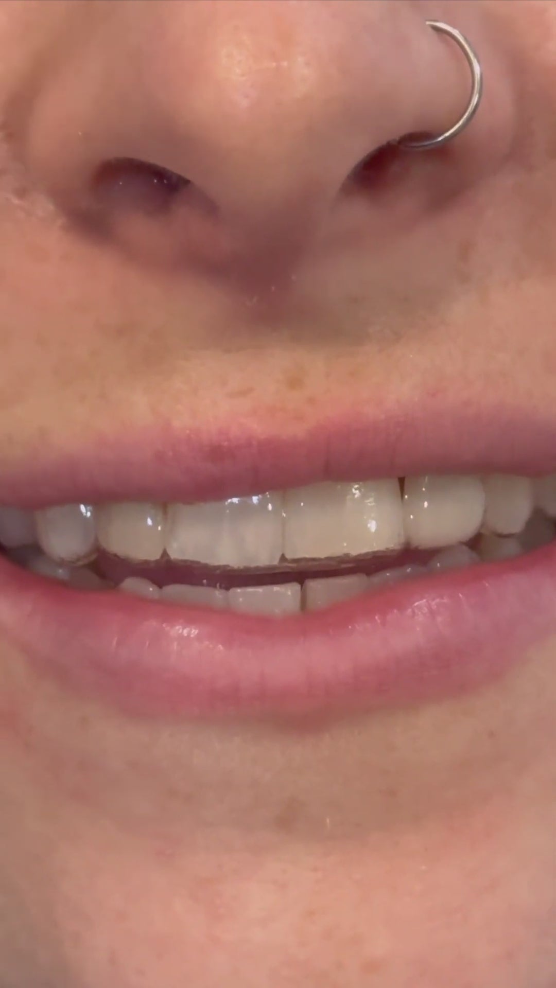 Woman wearing missing tooth retainer pontic essix retainer with fake tooth